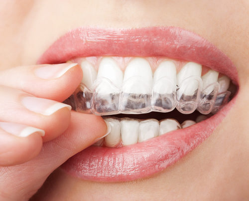 What Are the Health Benefits of Invisalign?